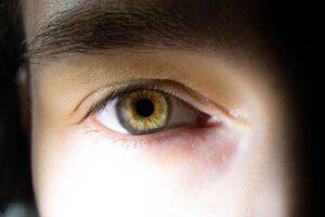 Iris-Heterochromie-Tag